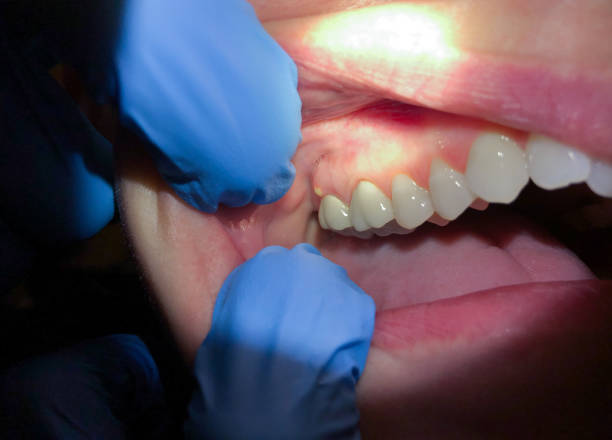 Best Emergency Dentist for Lost Fillings or Crowns in Lake Camelot, WI